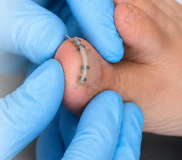 Nail Lift ingrown toenail correction treatment